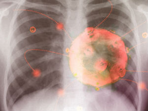 Kako izgledaju promene na plućima kovid pacijenata i koliko se brzo razvijaju